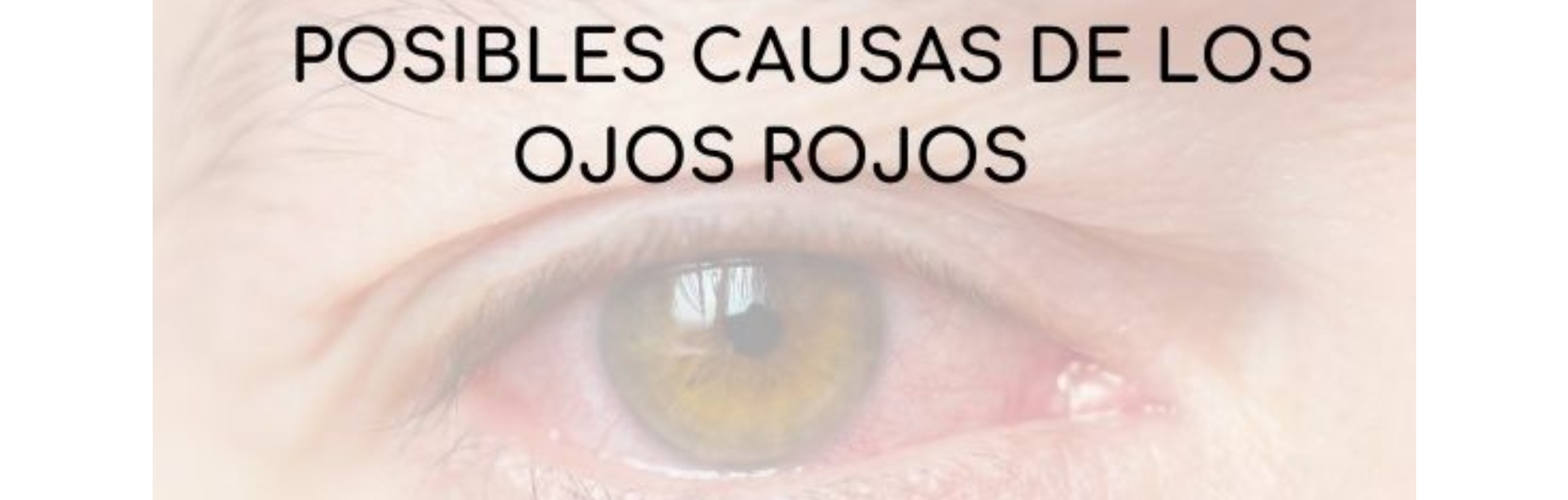 Posibles causas de los ojos rojos