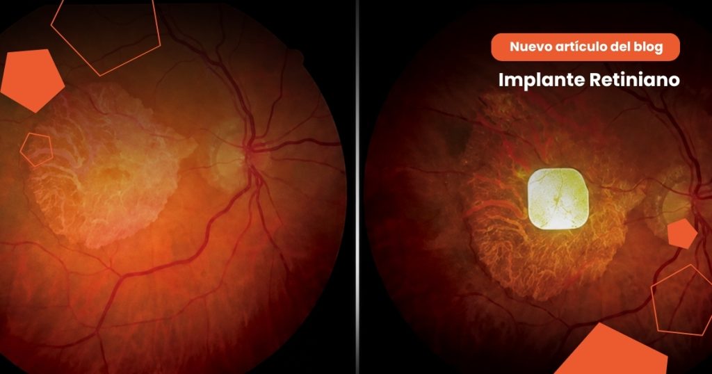 Europa aprueba un chip retinal que puede ayudar a recuperar parte de la visión 